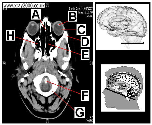 AXIAL SECTION 14.JPG